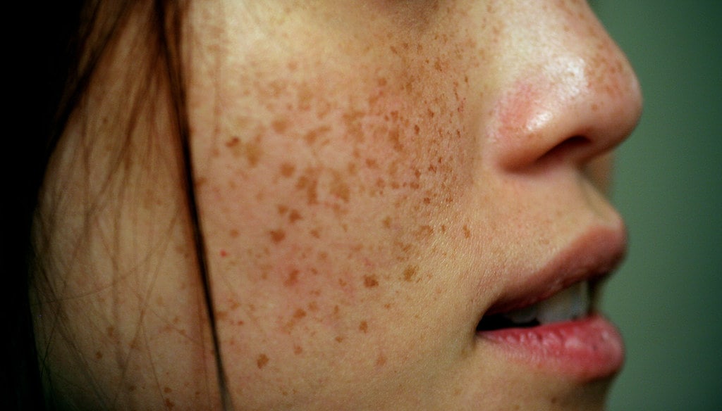 How To Get Rid of Freckles